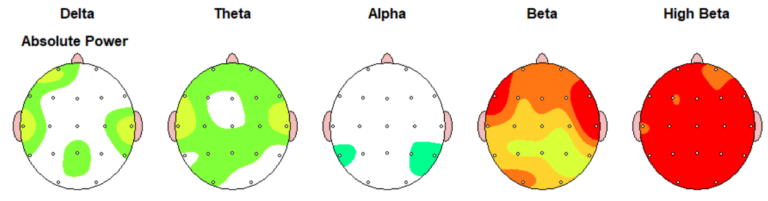 neurofeedback eeg caso de una mujer con ansiedad