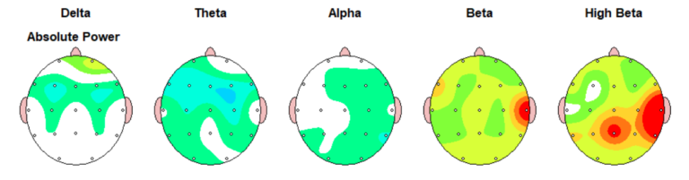 EEG neurofeedback